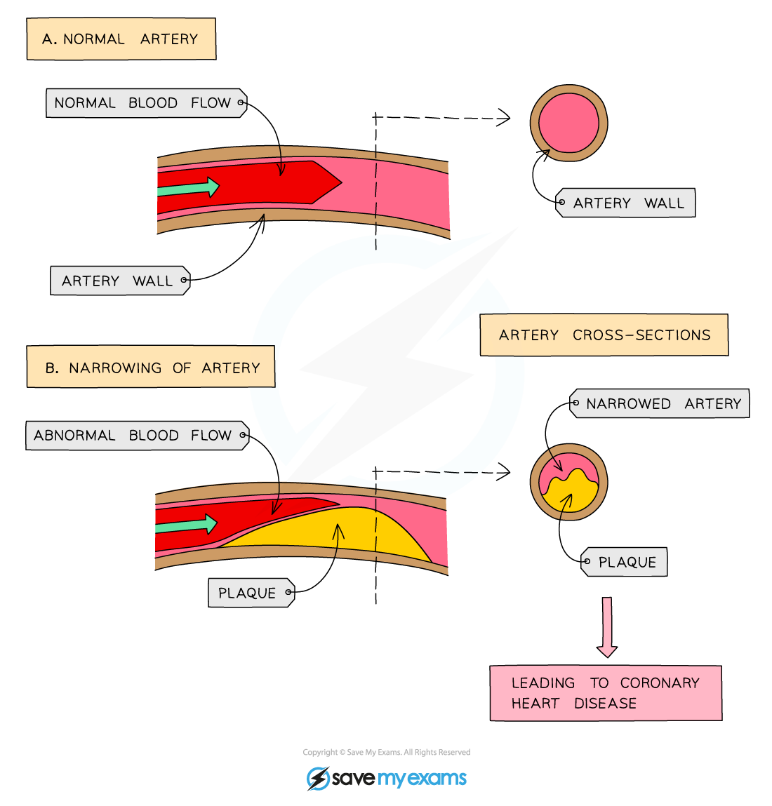 Effect of narrowing of arteries