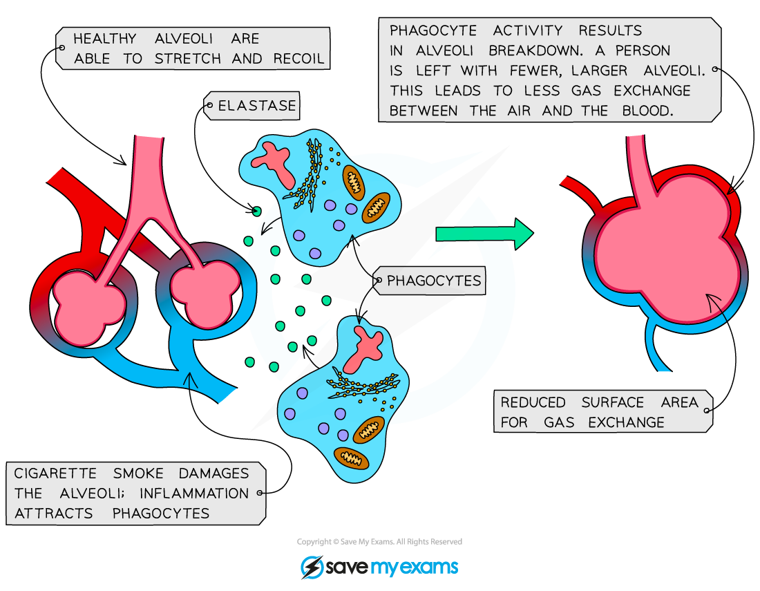 Emphysema in the lungs