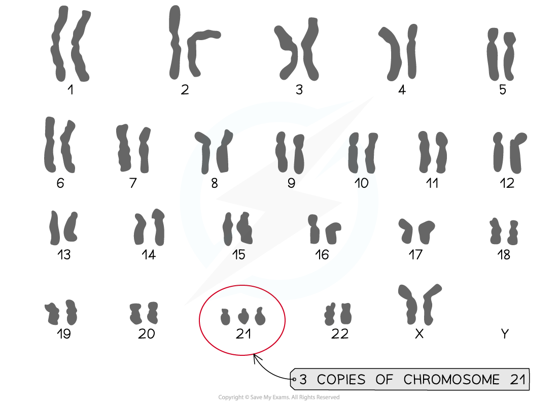 Karyogram showing Down Syndrome Karyotype