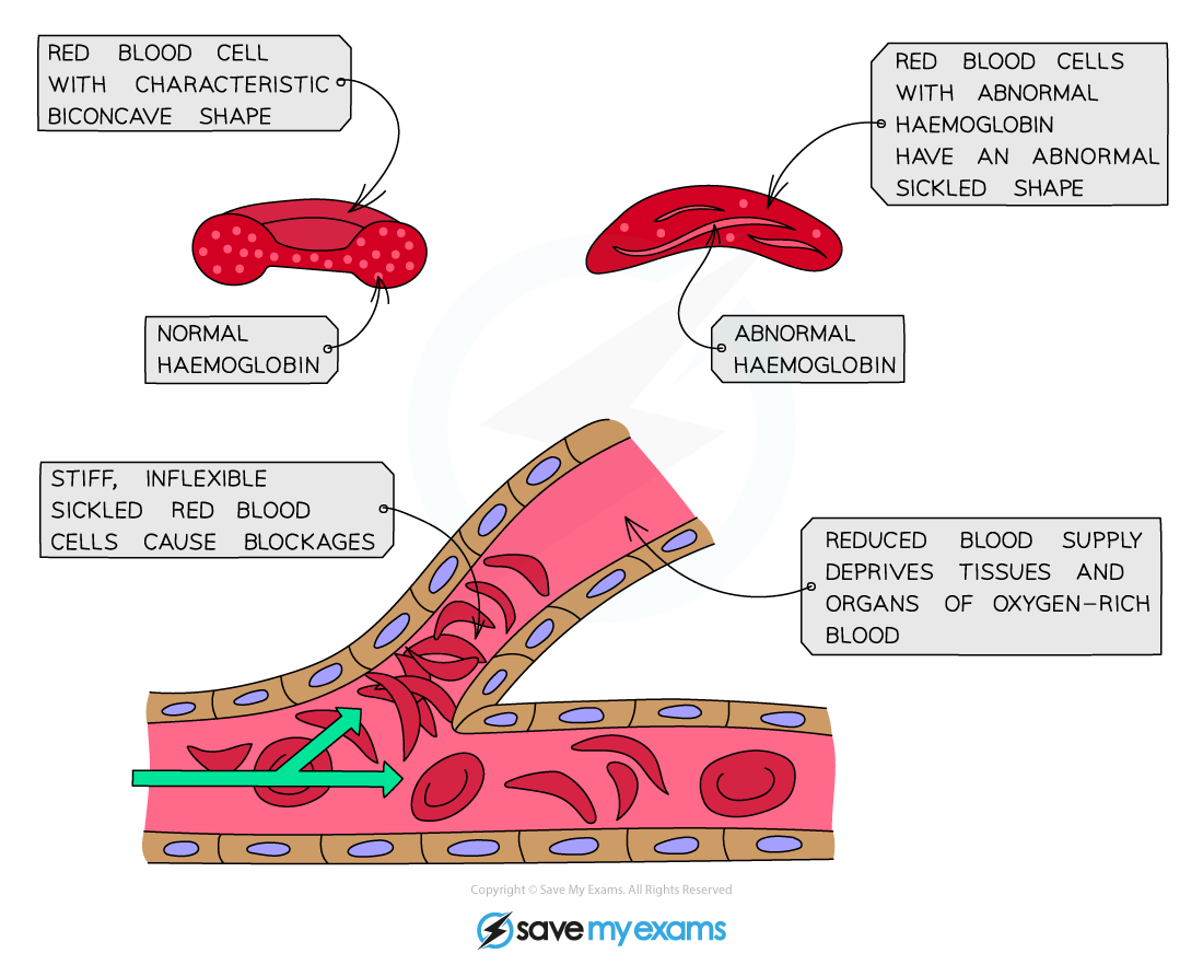 Sickle shaped red blood cells blocking the flow of blood