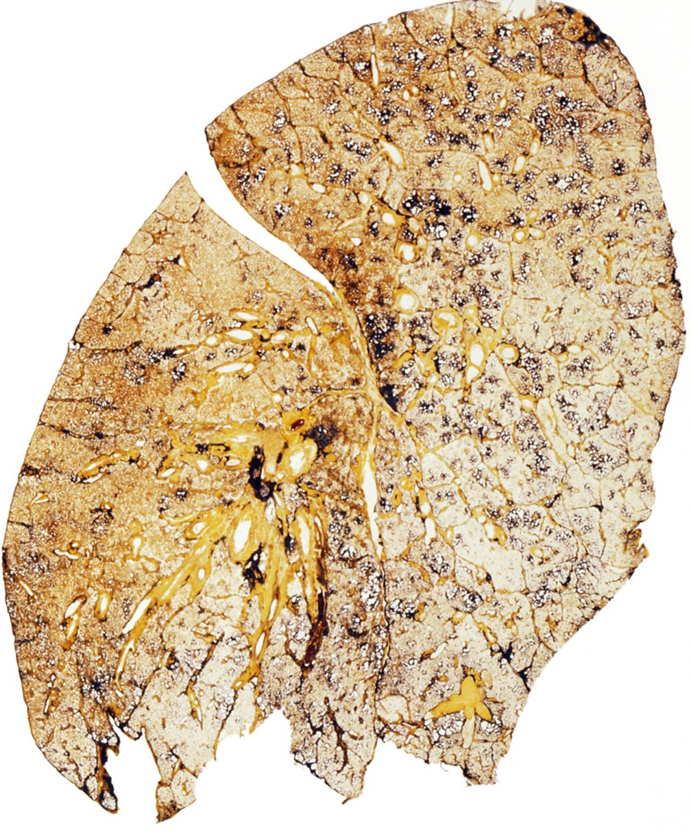 Smokers lung cross section